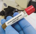 CSF sample for LDH (lactate dehydrogenase) test