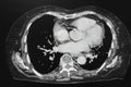 CT scan computed tomography of chest organs.