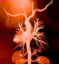 CT Angiography (Computed tomography angiography: CTA) of abdominal aorta