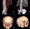 CT of body and head bones