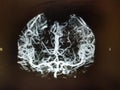 CT Brain angiography image on computer monitor
