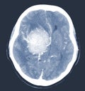 CT Brain Axial scans hyperdense mass with homogeneous, and mild perilesional brain edema at the right front-temporal-parietal