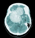 CT Brain Axial scans hyperdense mass with homogeneous, and mild perilesional brain edema at the right front-temporal-parietal Royalty Free Stock Photo