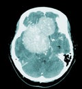 CT Brain Axial scans hyperdense mass with homogeneous, and mild perilesional brain edema at the right front-temporal-parietal