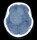 CT Brain Axial scans hyperdense mass with homogeneous, and mild perilesional brain edema at the right front-temporal-parietal Royalty Free Stock Photo