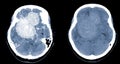 CT Brain Axial scans hyperdense mass with homogeneous, and mild perilesional brain edema at the right front-temporal-parietal Royalty Free Stock Photo