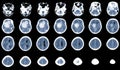 CT Brain Axial scans hyperdense mass with homogeneous, and mild perilesional brain edema at the right front-temporal-parietal Royalty Free Stock Photo