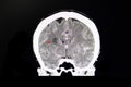 CT brain with contrast of a stroke patient Royalty Free Stock Photo