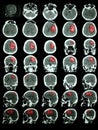 CT of the brain with hemorrhagic stroke