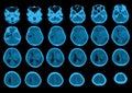 CT Brain History Headache Finding a 7 cm. extra-axial mass with stong enhancement and mass effect to left cerebral hemisphere,