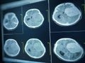 CT Brain impression a seven cm. extra-axial mass with stong enhancement and mass effect to left cerebral hemisphere.