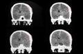 CT brain with large subdural hematoma
