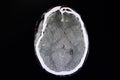 CT brain of head injury patient