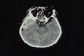 A CT brain scan of a patient with multiple fractures, epidural hematoma, and pneumocephalus