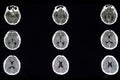 CT brain scan of ruptured cerebral aneurysm