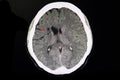 CT brain of a stroke patient Royalty Free Stock Photo