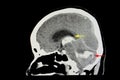 CT Brain Scan of Stroke Patient Royalty Free Stock Photo