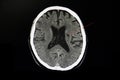 CT brain of a stroke patient Royalty Free Stock Photo