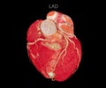 CT Cardiac 3D or CTA coronary artery