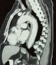 CT of Chest