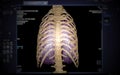 CT Chest with 3D rendering of lung and Rib.