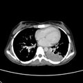 CT Chest Image of Lung Consolidation and Infiltrates