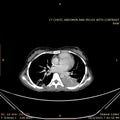 CT Chest Image of Lung Consolidation and Infiltrates