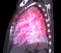 CT Chest or Lung 3d rendering image  showing Trachea and lung in respiratory system Royalty Free Stock Photo