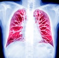 CT Chest Lung preset for detected tuberculosisTuberculosis (TB) and coronavirus 2019.