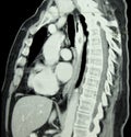 CT of Chest and Spine