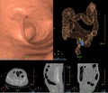 CT colonography compare 2D Axial,sagittal ,coronal plane and 3D rendering image