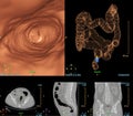 CT colonography compare 2D Axial,sagittal ,coronal plane and 3D rendering image