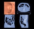 CT colonography compare 3D and 2D Axial,sagittal ,coronal plane