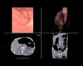 CT colonography or CT Scan of Colon.