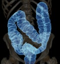 CT colonography or CT Scan of Colon 3D Rendering image AP view showing colon for screening colorectal cancer.