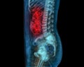 CT colonography or CT Scan of Colon 3D Rendering image for screening colorectal cancer. Check up Screening Colon Cancer
