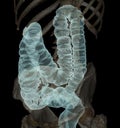 CT colonography 3D Rendering image showing colon for screening colorectal cancer.