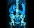 CT colonography or CT Scan of Colon 3D Rendering image for screening colorectal cancer. Check up Screening Colon Cancer