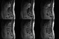 CT Computed tomography scans of human spine on a ultrasound computer monitor. Part three