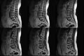 CT Computed tomography scans of human spine on a ultrasound computer monitor. Part two