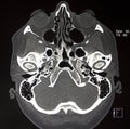 CT of cranial bones