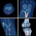 CT knee Fracture of intercondylar eminence of tibia Royalty Free Stock Photo