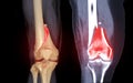 CT knee joint 3D rendering image Front view and Coronal view isolated on black background showing fracture Femur bone