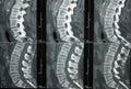 CT of Lumbar Spine Royalty Free Stock Photo