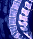 CT of Lumbar Spine, Sagittal plane Royalty Free Stock Photo