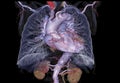 CTA Chest with Lung 3D rendering image.