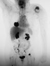 Ct right lower lobe mass primary lung neoplasm