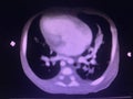CT scan angiogram show dextrocardia the congenital heart disease