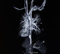 Ct scan angiogram (take photo from film x-ray) Royalty Free Stock Photo