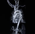 Ct scan angiogram (take photo from film x-ray) Royalty Free Stock Photo